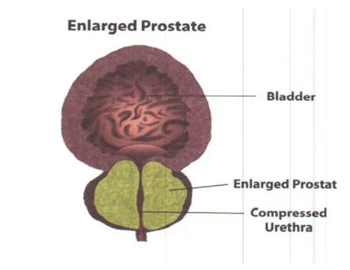 The image is a diagrammatic representation of the human reproductive system, specifically focusing on the male genitalia and urinary tract, with labels such as  Enlarged Prostate,   BLOOD VESSEL,   TESTICLE,   COMPRESSED PROSTATE,   UTRHRA,  and  BLADDER.