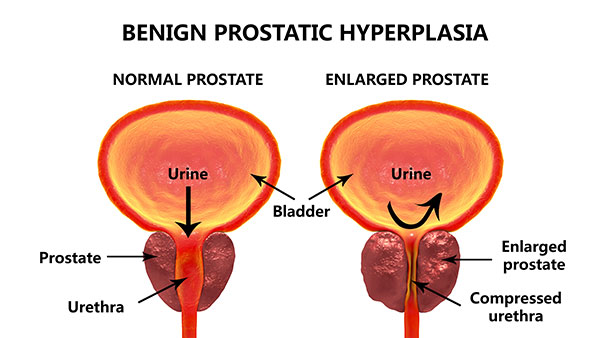 The image is a medical illustration showing the anatomical relationship between the kidneys, bladder, and prostate gland in a male human body.