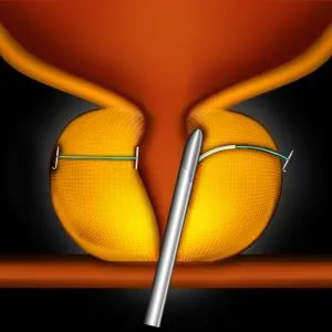 The image shows a close-up of a surgical instrument, specifically a laparoscopic trocar, with an orange mesh cover and a metal cannula inserted into it, placed on a black background.
